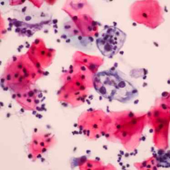 Carcinom cu celule scuamoase – ce tipuri exista, diagnostic si tratament