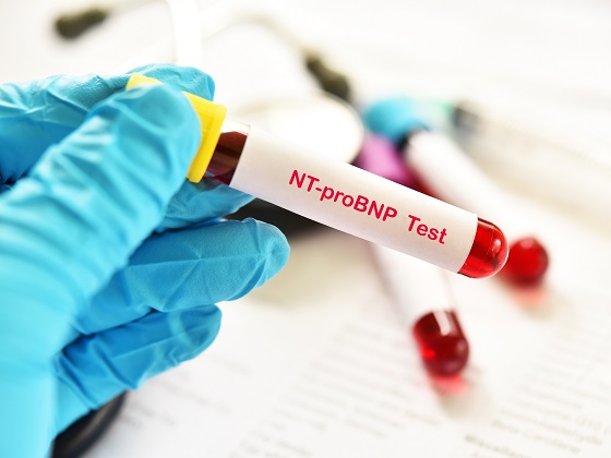 NT-proBNP-test