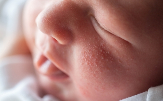 Ce este si ce cauze are acneea bebelusului