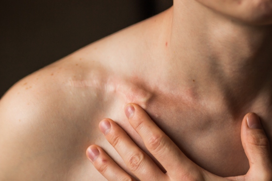 Clavicula umflata: cauze, afectiuni asociate, tratament