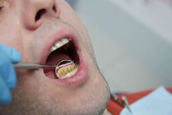 Tartru dentar - metode de preventie