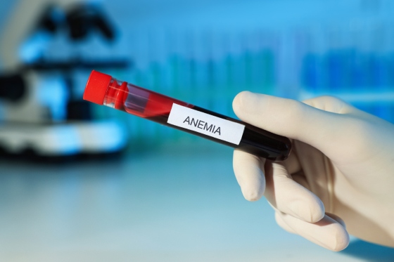 Cum identificati anemia? Informatii analize anemie