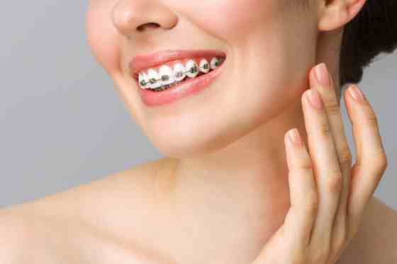 Afectiuni bucale cauzate de purtarea aparatului dentar