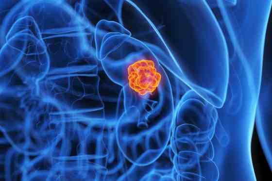 Glomerulonefrita - tipuri, cauze, simptome si complicatii