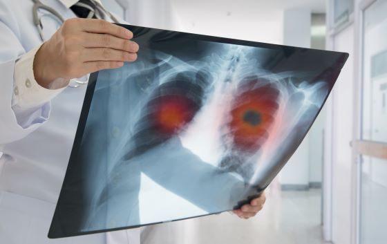 Cancer pulmonar – cauze, factori de risc, simptomatologie si preventie