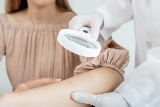 Sindromul Sweet: cauze, simptome, diagnostic, tratamente si solutii