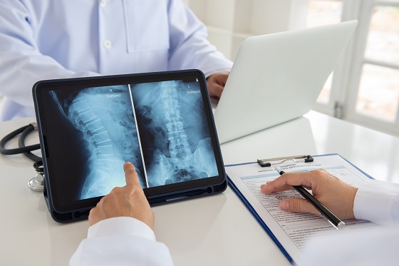 Osteofitoza – tipuri, cauze, simptome si tratament