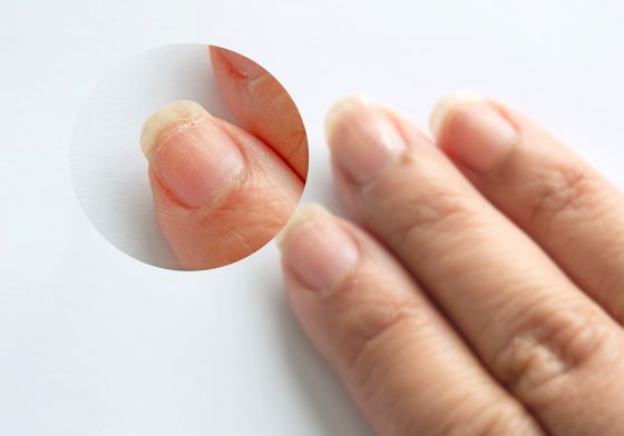 Micoza unghiei: cauze, factori de risc si remedii