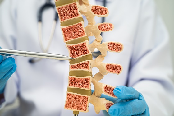 Totul despre calciu in osteoporoza: cat, cum si cand sa il administrati