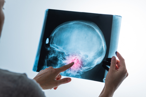 Sindrom Arnold Chiari: ce este si cum este diagnosticat