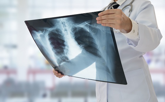 Tuberculoza (TBC) – transmitere, simptome, tratament si prevenire
