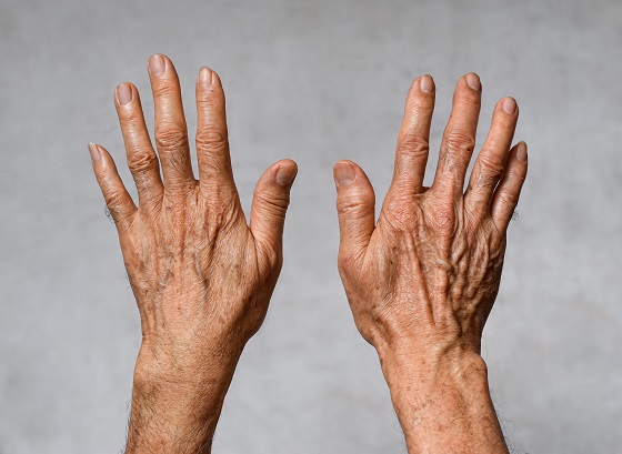 Ce este si cum tratati eczema degenerativa? Sfaturi medicale si solutii