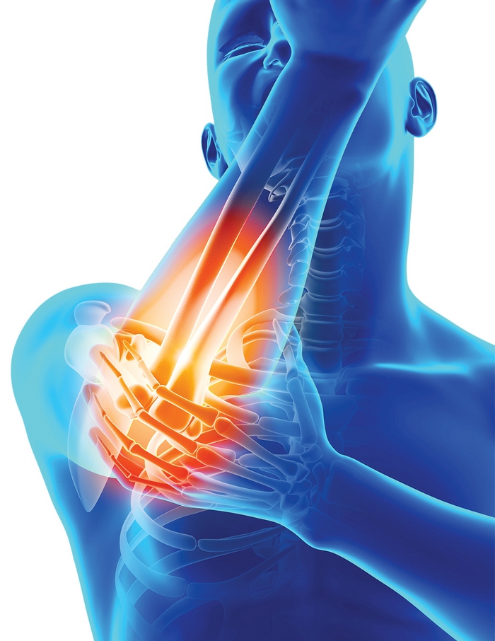 Cauzele frecvente ale durerii la nivelul braţelor | Panadol