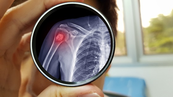Encondrom: ce este, ce cauze are, diagnostic si tratament
