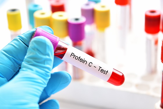 Ce este si ce efecte are deficitul de proteine asupra organismului?