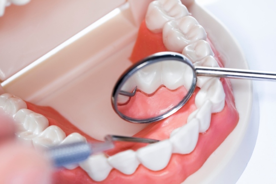 Odontoliza sau eroziunea dentara: cauze si solutii