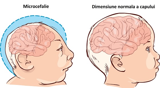 Microcefalie: cauze, simptome, complicatii