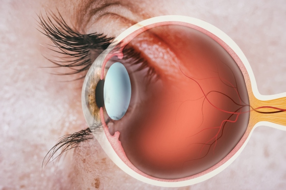 Retinopatie pigmentara – cauze si tratament