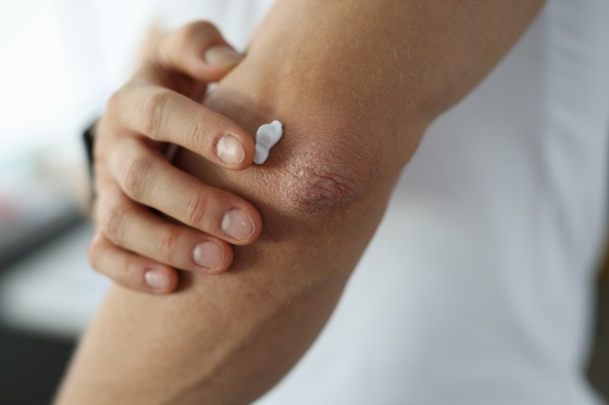 Cum alegeti corect crema pentru dermatita atopica
