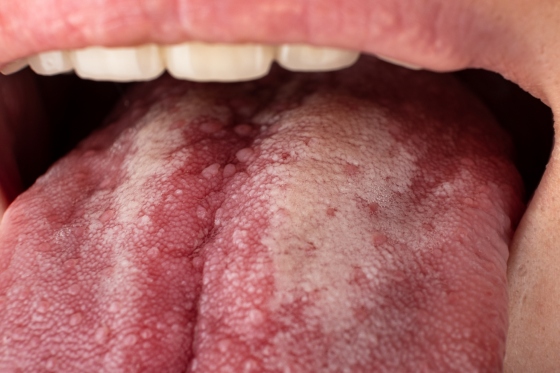 Glosodinie: cauze, simptome, diagnostic, tratament pentru ameliorarea durerii