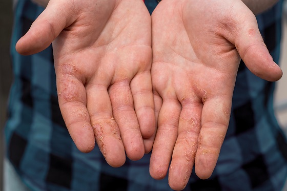Ce declanseaza eczema dishidrotica si cum o puteti preveni in sezonul cald?