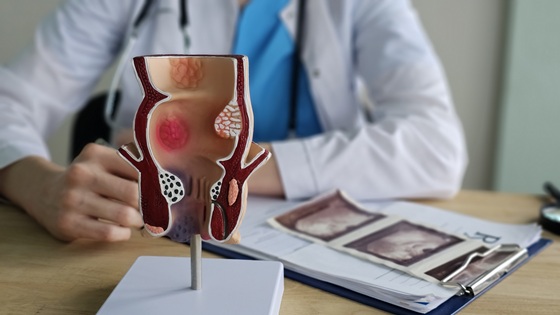  Regim alimentar de ajutor pentru persoanele care se confrunta cu hemoroizi
