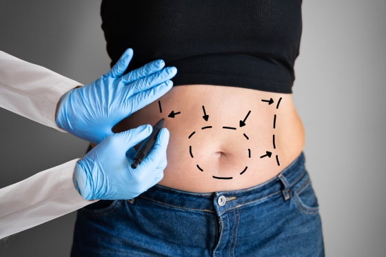 Abdominoplastie: ce este, cand se recomanda, ce beneficii are?