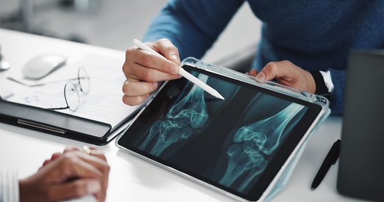 Osteoporoza: cauze, factori de risc, simptome, tratament si preventie