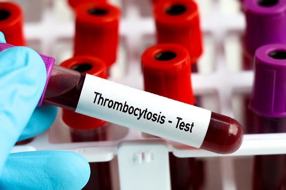 Trombocitoza (trombocite crescute) – cauze si tratament