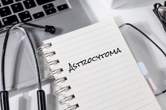 Astrocitom: ce este, cauze, simptome, tratament, complicatii