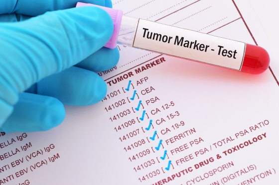 Analize markeri tumorali - informatii utile