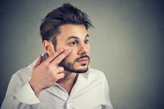 Edem palpebral dimineata: de ce apare si cum sa-l preveniti?