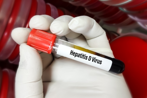 Hepatita D (HVD) - ce este si cum se manifesta