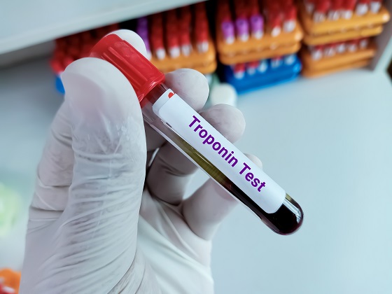 Troponina – ce este, valori normale, cauze pentru troponina mare