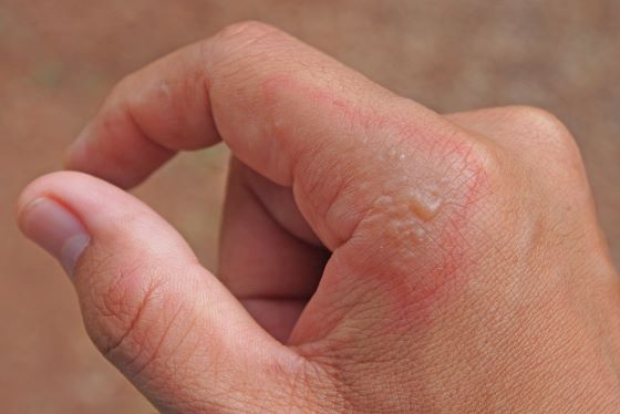 Impetigo bulos – ce este, cauze, factori de risc, tratament