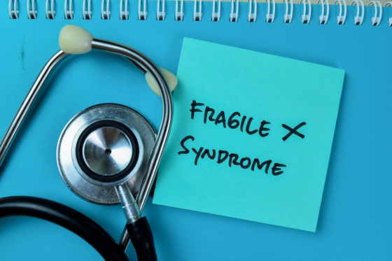 Sindrom X fragil: cauze, simptome si optiuni de tratament