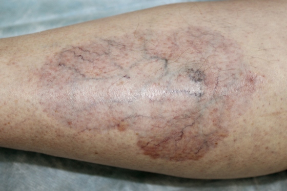 Necrobioza lipoidica: ce este, cum se manifesta pe piele, legatura cu diabetul zaharat si alte afectiuni