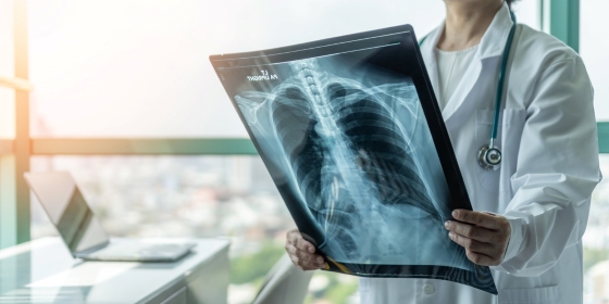 Radiografie toracica: ce este si cand este recomandata