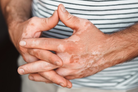 Vitiligo: cauze, factori de risc, diagnostic si tratament