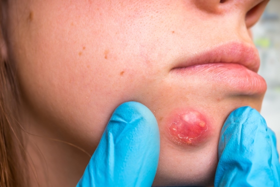 Furuncul antracoid: cauze, simptomatologie, tratament