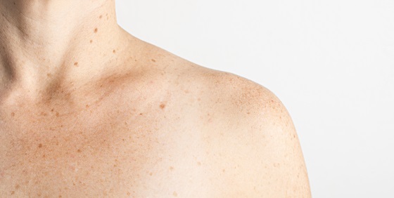 Papiloamele si cancerul de piele: legaturi si precautii