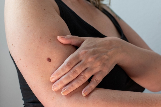 Cancer de piele – cauze, factori de risc, manifestari, diagnostic, preventie