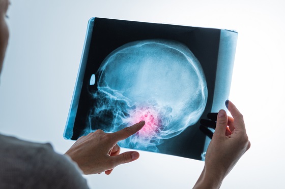 Glioblastom sau gliom cerebral de gradul IV - informatii complete