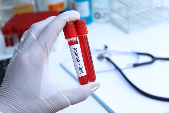 Anemie acuta versus anemie cronica – ce trebuie sa stiti?