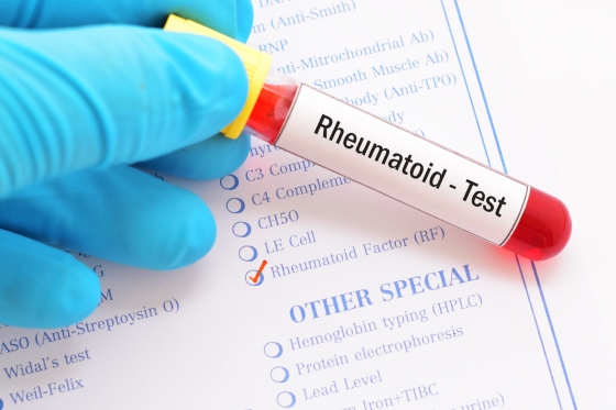 Factor reumatoid – valori normale, valori crescute, interpretare