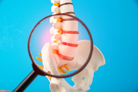 Spondilolistezis: tipuri, cauze si factori de risc, simptome, tratament, preventie