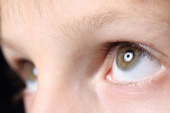 Cataracta congenitala la copii: cauze si solutii de tratament