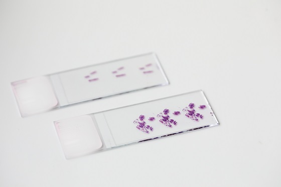 Germinom: ce este, ce cauze si factori de risc exista, diagnostic si tratament