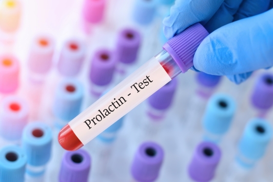 Hiperprolactinemie: cauze si factori de risc, simptome, diagnostic si solutii