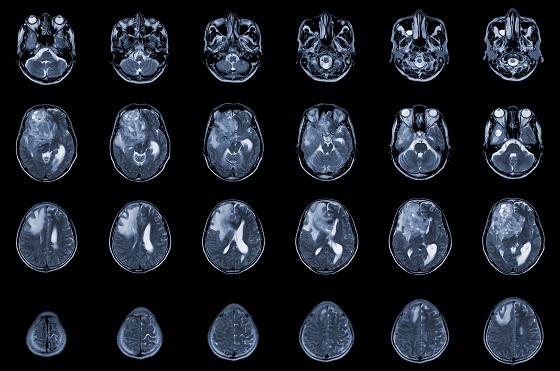 Tumora pineala: ce este, tipuri, simptome, diagnostic si tratament